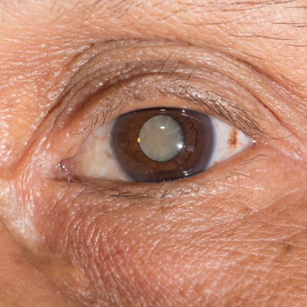 Cataract Lifetime Eye Care Lewiston
