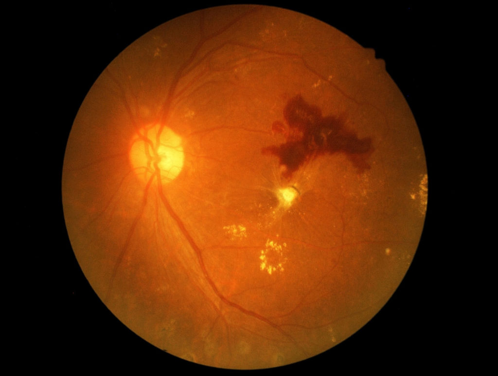Retinal Hemorrhages
