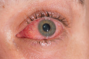 eye disease doctor clarkston wa lewiston idaho